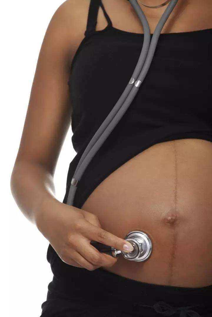 生女孩的妊娠线图片图片