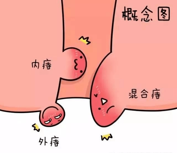 临床上又分为内痔,外痔,混合痔.