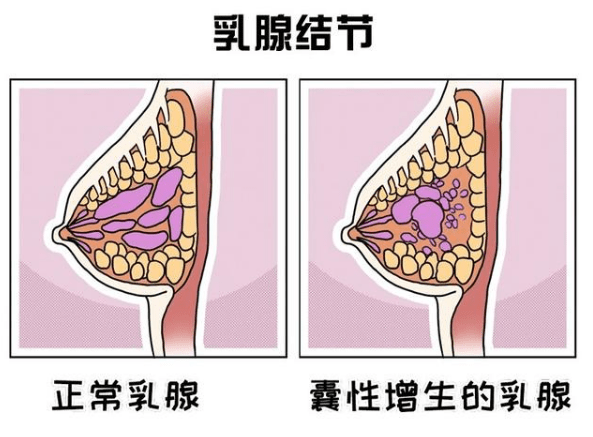 乳腺癌肥胖——癌症相比较之下,这些都算是小问题,不太为人所了解的是