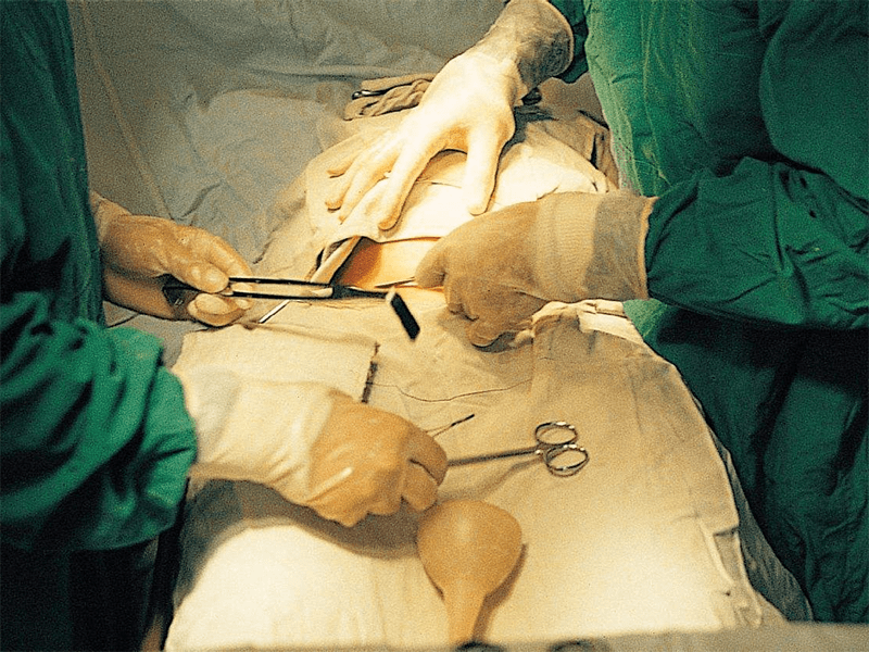 剖腹产对女性有危害月子期如何收紧松弛大肚腩健康恢复