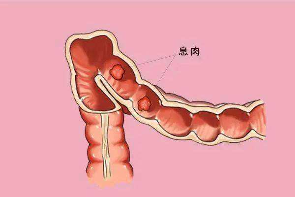 结肠息肉不容忽视小小一个癌变率高