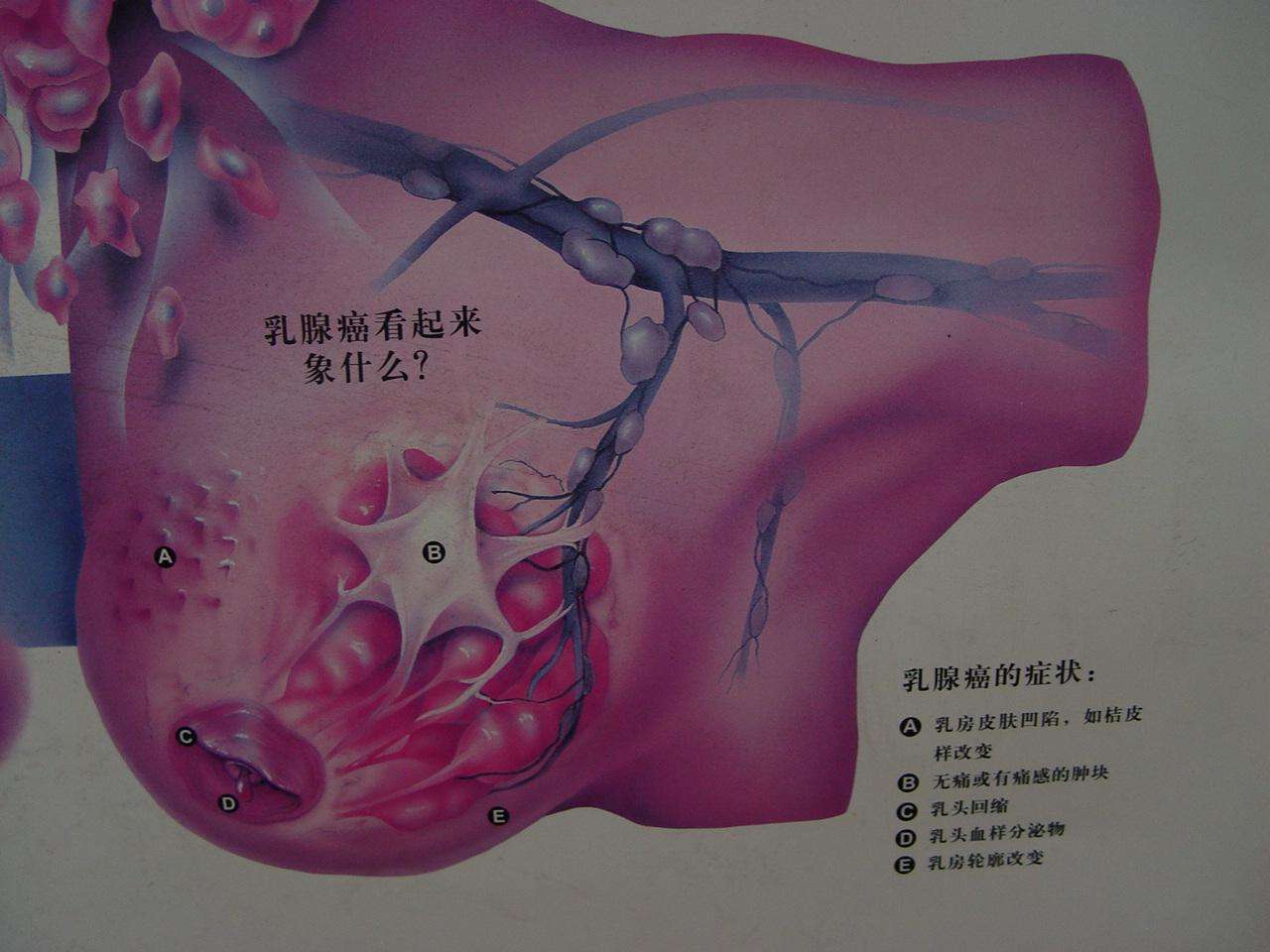 女性朋友要做好乳腺癌早期篩查_檢查