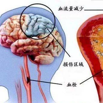 脑栓塞示意图图片