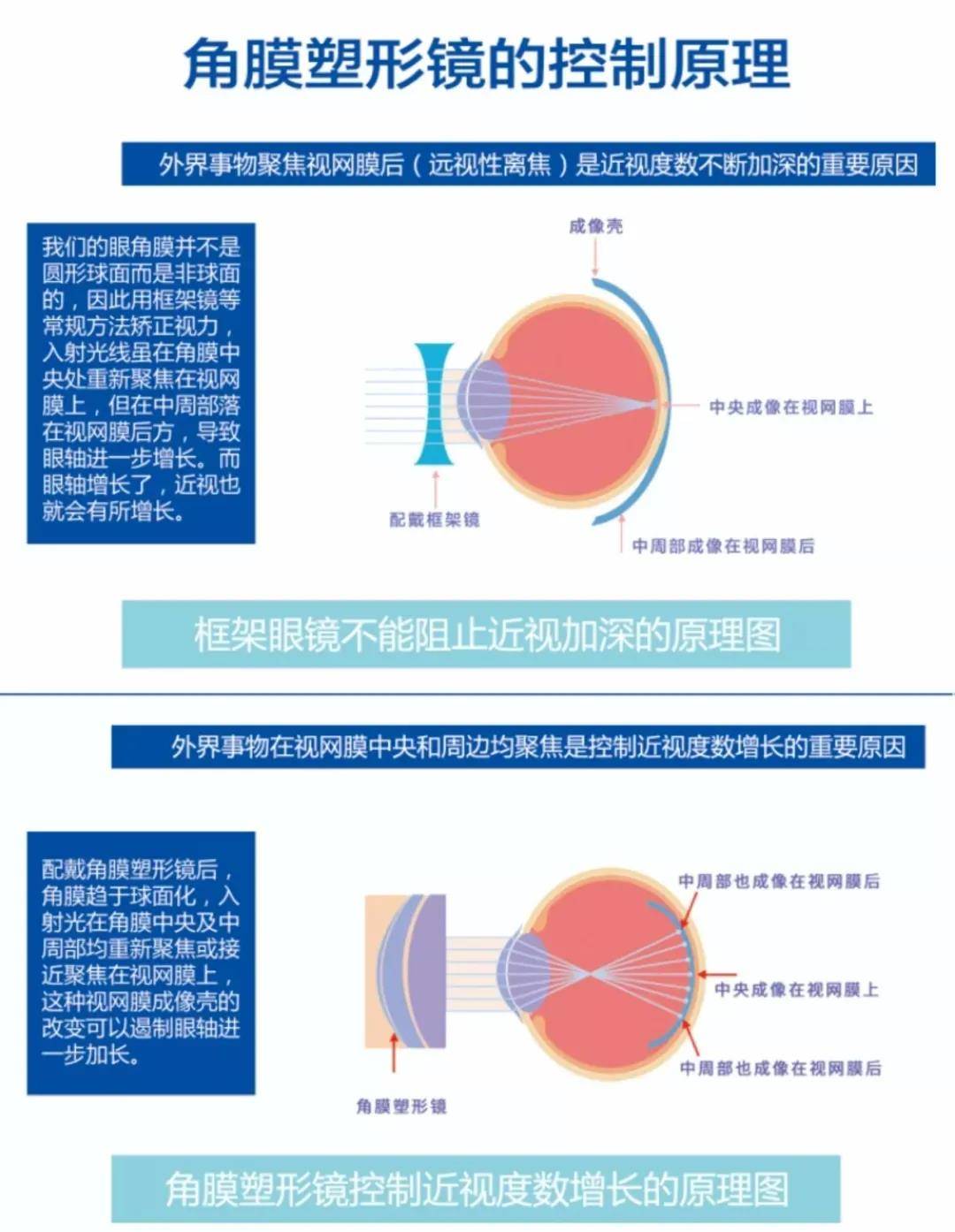 愛爾角膜塑形鏡不做近視手術也能日常視力10