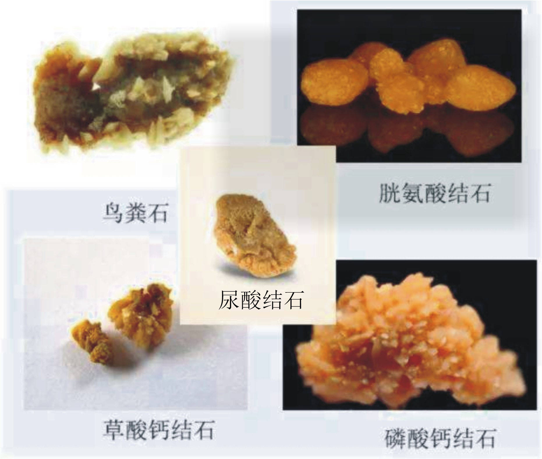 1,草酸钙结石:最为常见,占肾结石的80%以上,在酸性或中性尿中形成