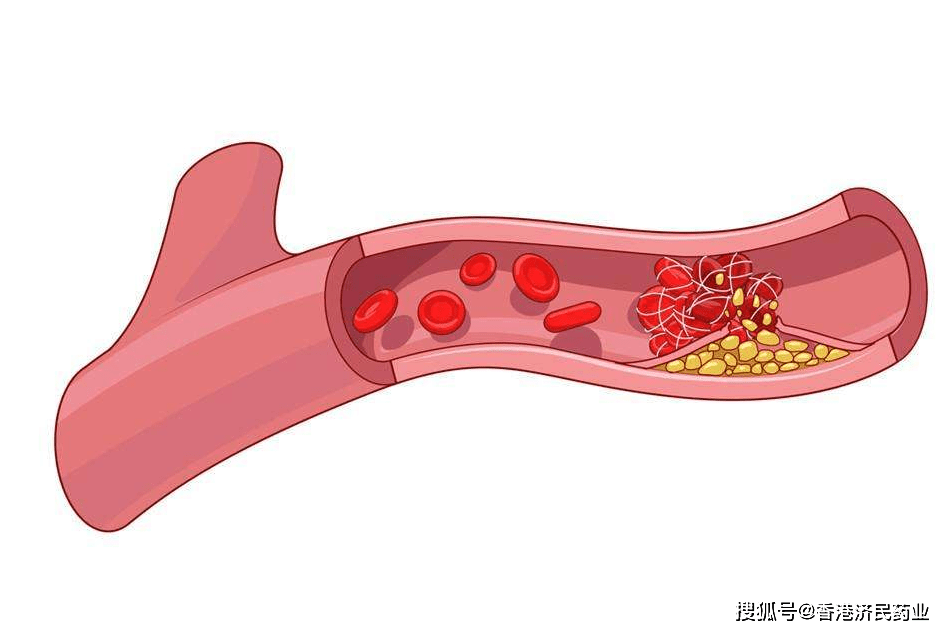 chmp建议批准抗凝血剂pradaxa达比加群酯用于儿科vte及预防复发_手机