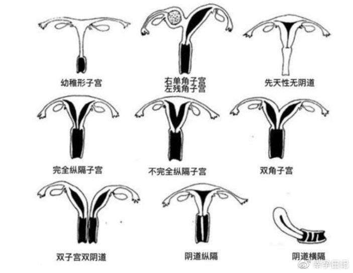 子宫畸形种类图片