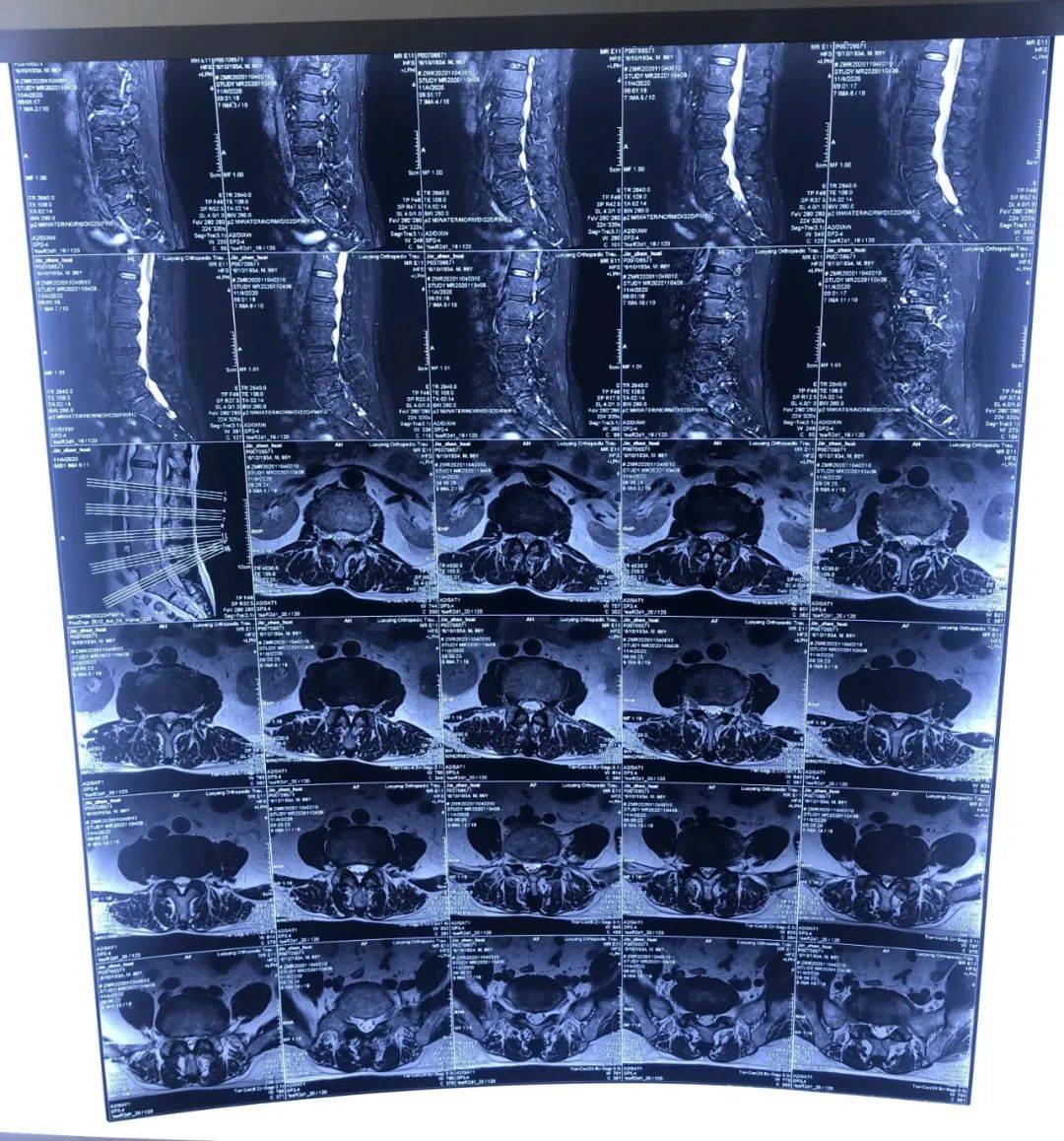 开封市第二中医院超声引导下的侧隐窝阻滞技术解除耄耋老人腰突痛苦