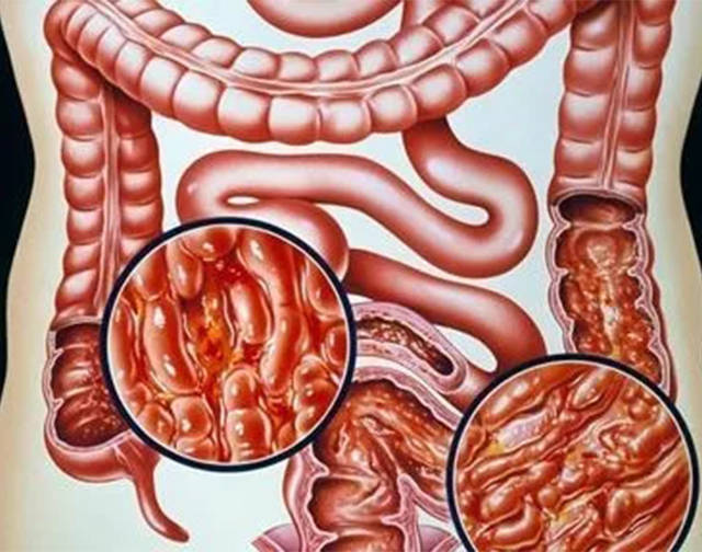 反复腹泻腹痛要当心炎症性肠病有肠梗阻瘘管癌变风险
