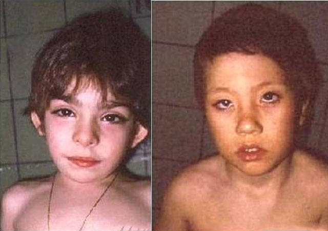 歌舞伎面谱综合征是个什么病 歌舞伎面谱综合征能治吗 新媒公社