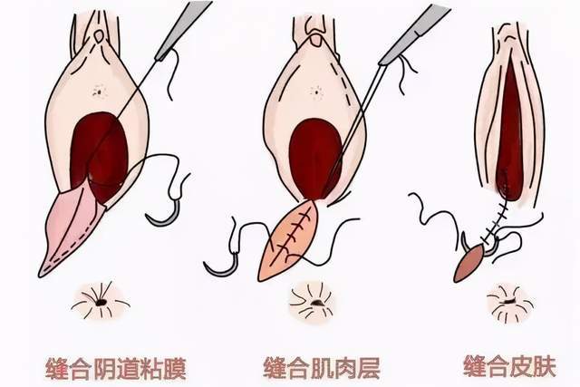 順產時側切或撕裂能否對產婦生活造成影響先了解一下