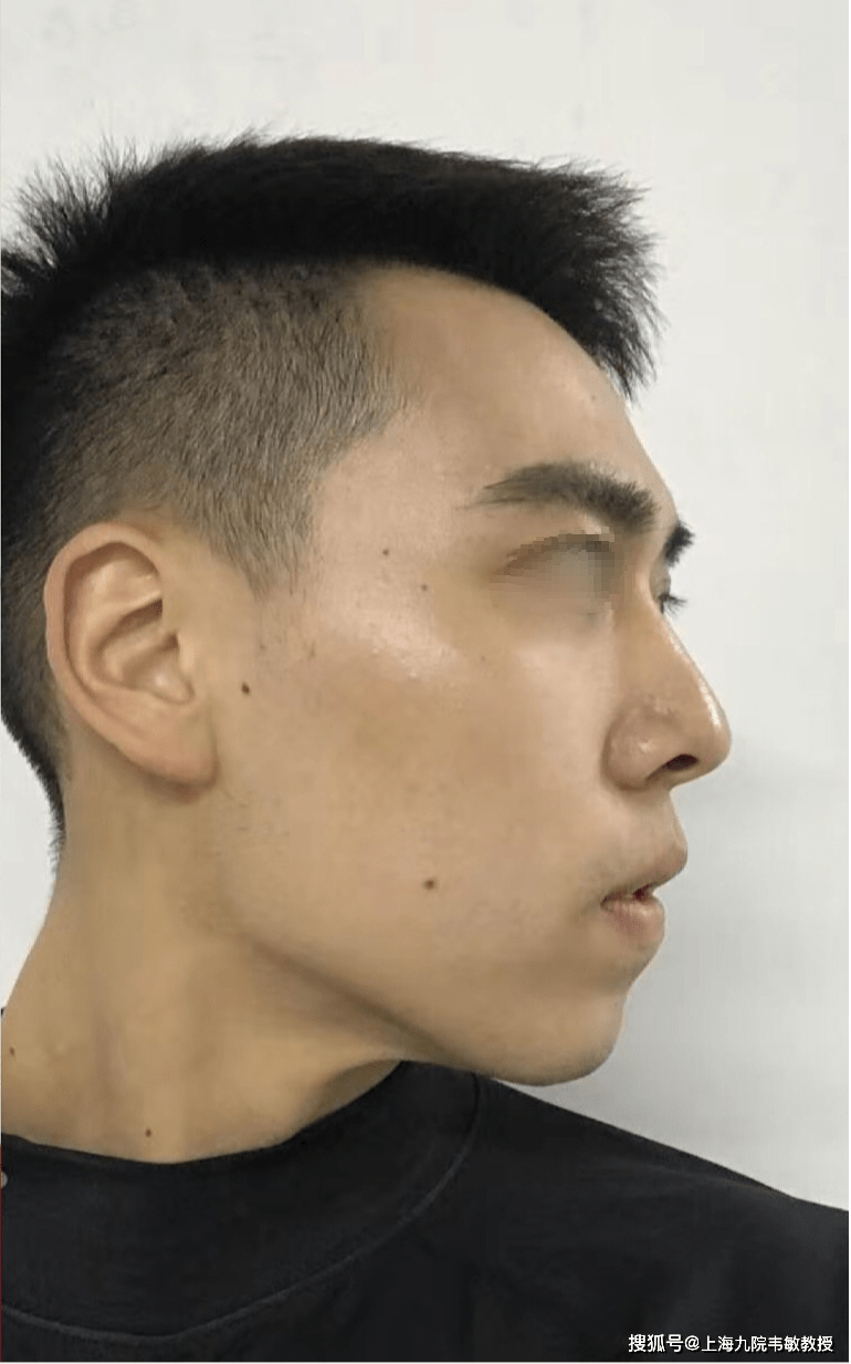 上海九院韦敏教授 i 别让下巴耽误了你的侧颜