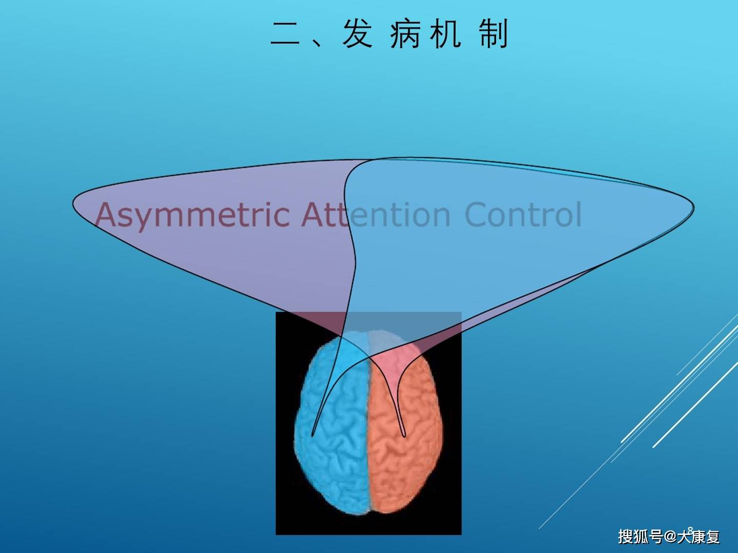 偏侧空间忽略症