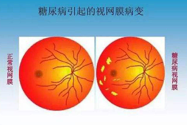 眼科专家张红糖尿病者眼睛视力下降模糊黑影警惕肾病并发症