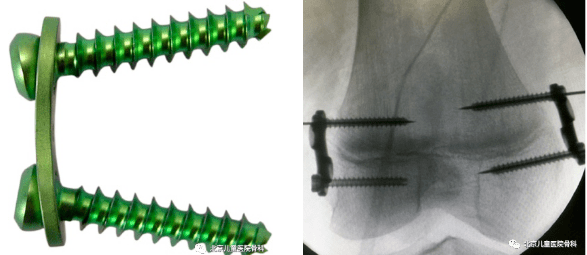 天玑动态天玑骨科手术机器人辅助完成儿童下肢8字钢板手术