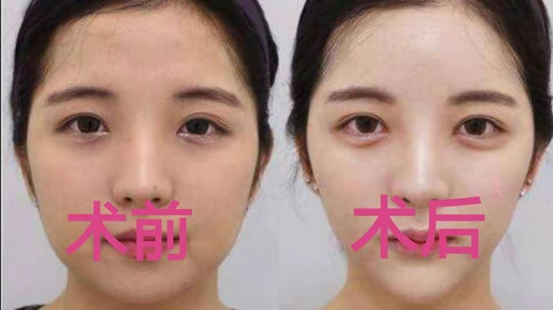 热玛吉有用吗热玛吉效果怎么样 其实变美也隐藏着秘密