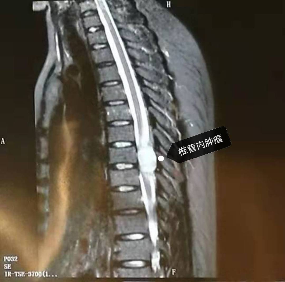 揭阳揭东集和医院开展脊柱肿瘤手术