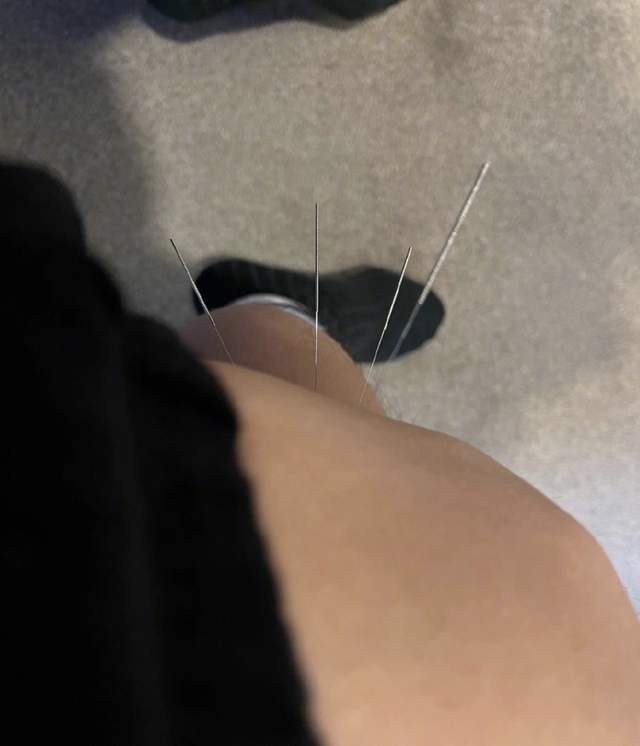 邓超为一双儿女做榜样,以身试针,调侃说是"针模"