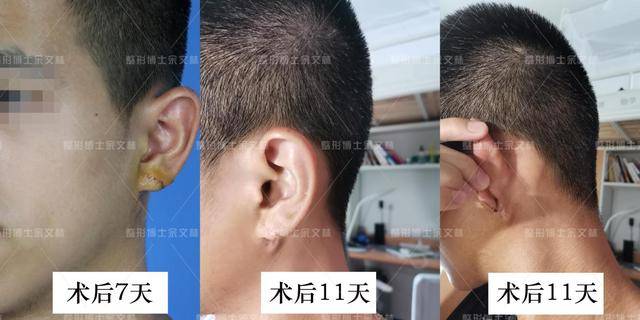 耳垂畸形修复术后耳朵会留疤吗?