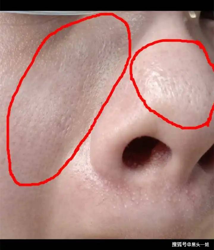 秋冬脸上用黑色衣服一擦就会有白白的东西是太干了缺水导致的脱皮爆皮