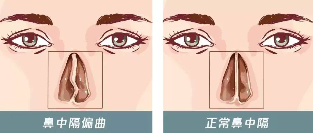 贵阳铭仁耳鼻喉医院女子鼻孔常常有血误认为是感冒一查竟是鼻中隔偏曲