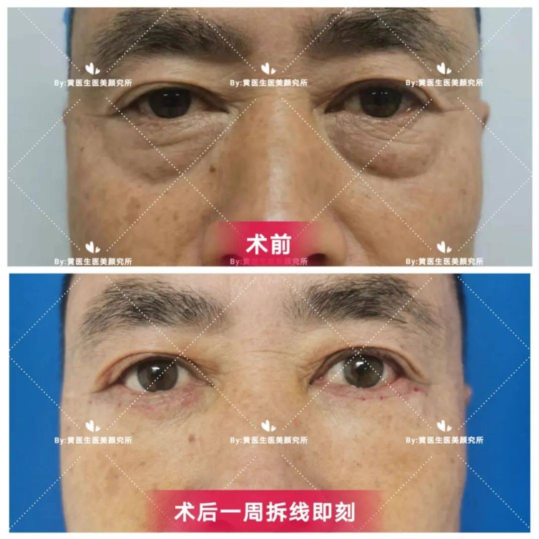 外切眼袋案例展示5