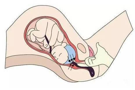 1.卧床休息在孕中期被确诊为胎盘低置的话,准妈妈最好卧床静养.