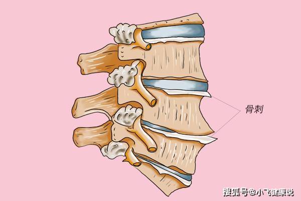 骨刺竟是好东西?患有骨质增生并不是坏事,不能乱治,别再被骗了
