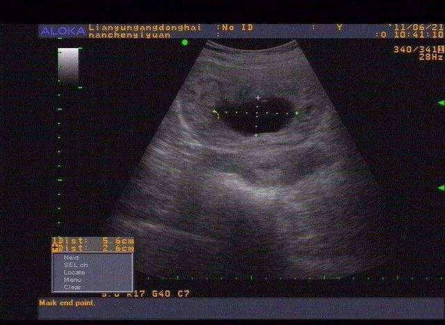 40天的怀孕彩超图片图片
