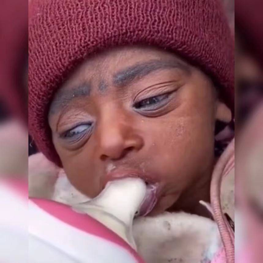 早衰症宝宝喝奶的过程令人揪心不已网友希望可以健康成长