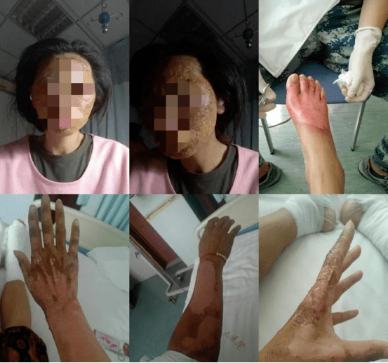 房车爆燃之后:昔日模特面部烧伤 7年翻12倍的市场"野蛮生长"