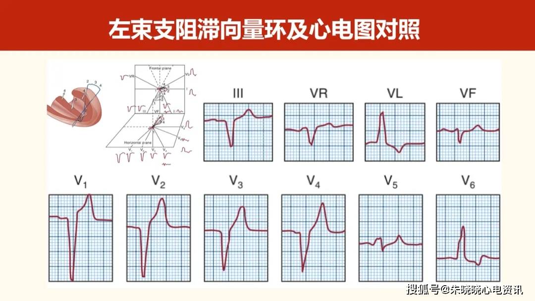 心电向量图图解图片