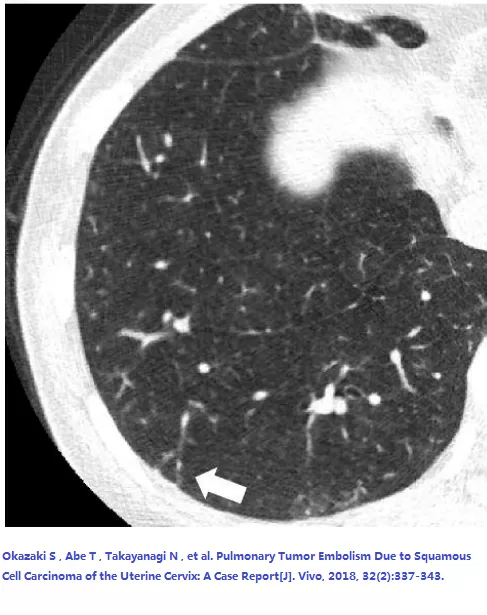 医院后第四天,患者呼吸衰竭死亡(her condition rapidly deteriorated