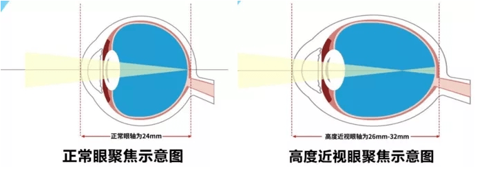 老年性|你知道吗？这几类人需定期给眼睛“体检”