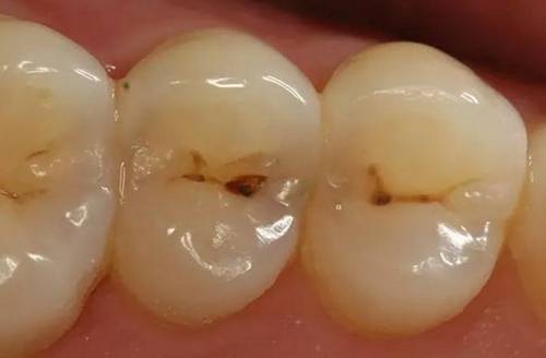 的不是江湖郎中的"捉牙虫",也不是无良商家的"漱口水漱口就能治蛀牙"