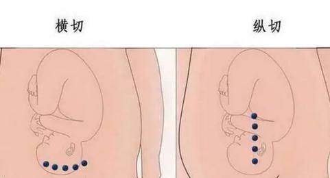 剖腹产刀口位置图图片