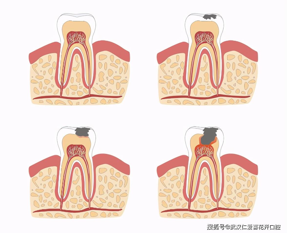 病变只限于牙釉质或牙骨质,在牙冠平滑面上,由于牙釉质脱钙,牙表面