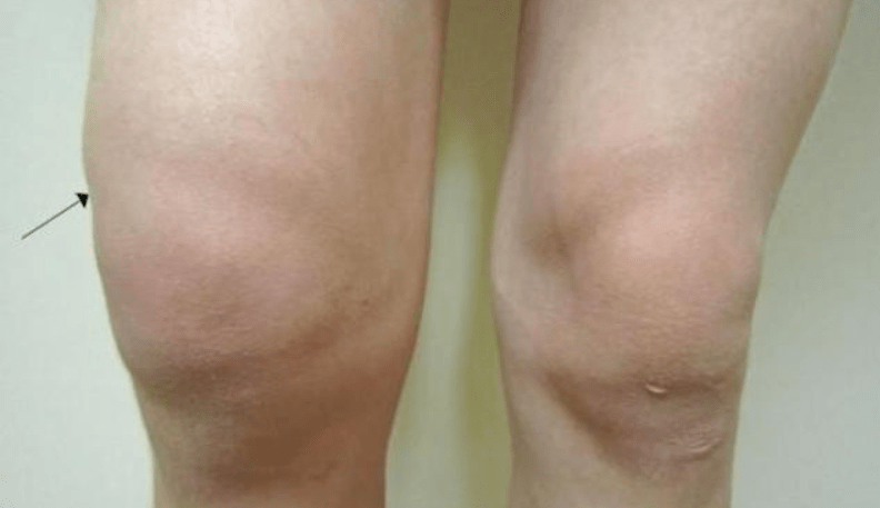 膝盖滑膜炎的治疗药 47a84237724a43398a21ff471d800549.png