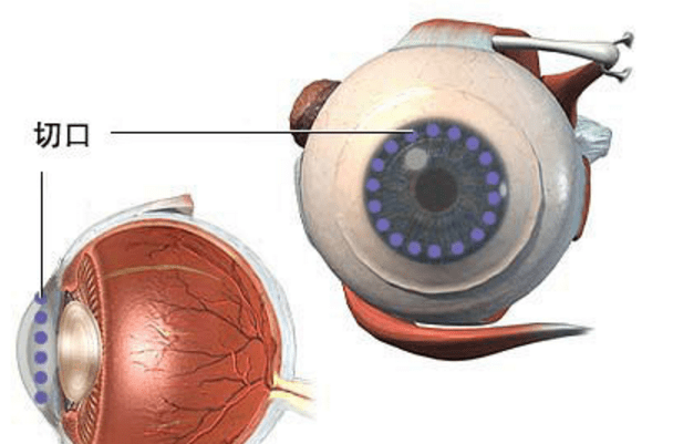 数百万人的救命稻草角膜移植你知道多少