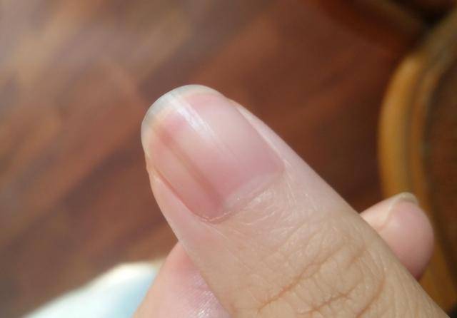 肝硬化指甲症状图片图片