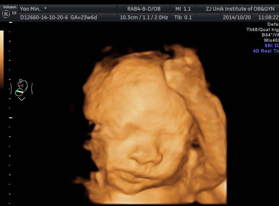 孕妇做四维彩超胎儿鼻子扁又大胎儿也是有苦说不出啊