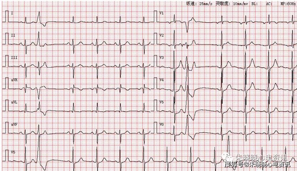 左前分支阻滞心电图图片