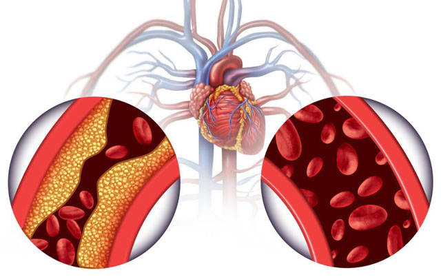 心臟病早期有哪些預警信號預防心血管堵塞如何合理用藥