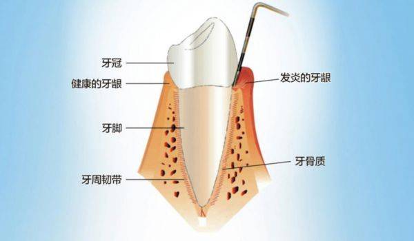 牙周组织包括图片