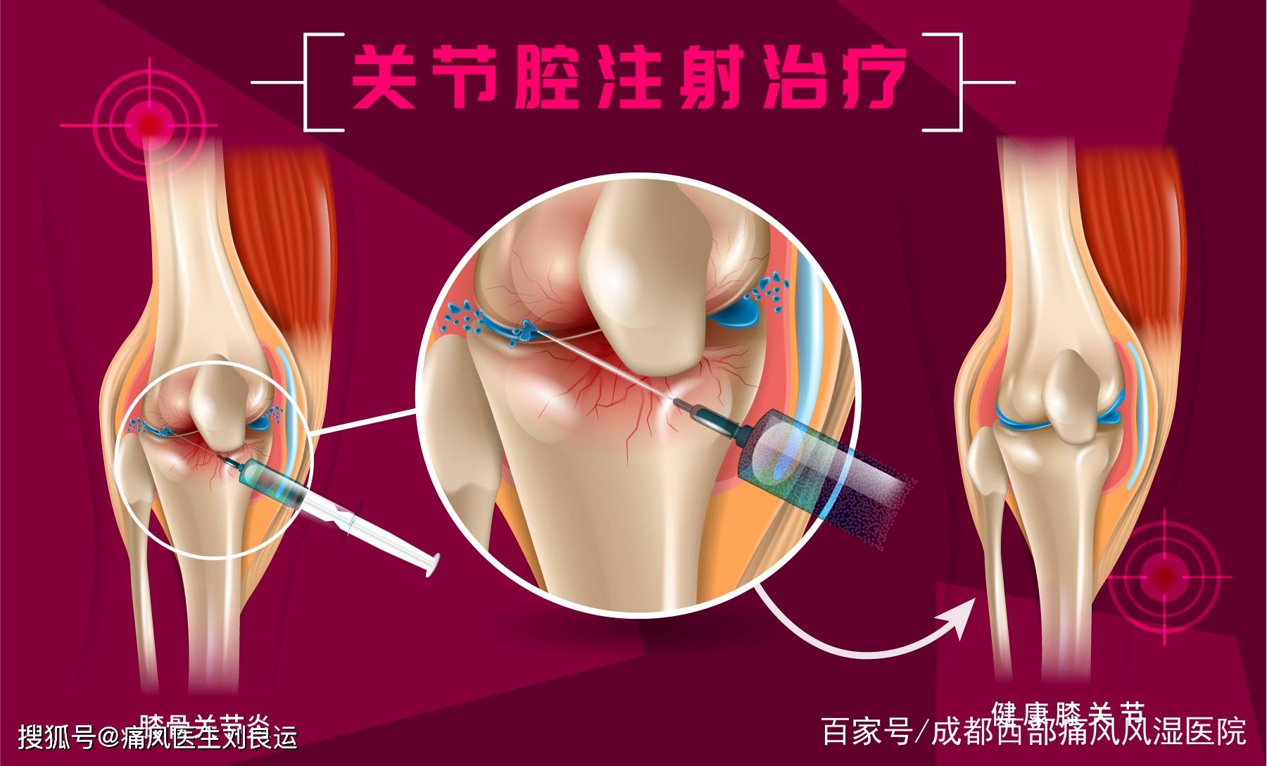 吃激素多膝盖痛怎么办