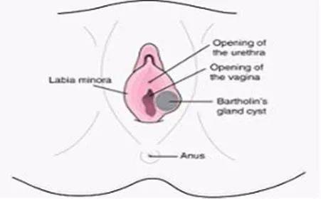 前庭大腺囊肿是女人专有的 局部