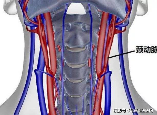 颈动脉瘤位置图片图片
