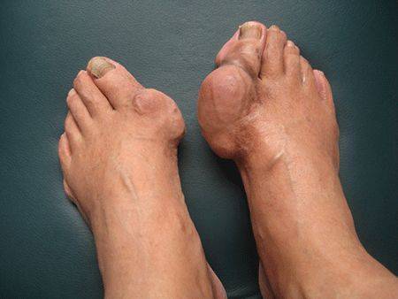 痛风不到一年就长"痛风石",这些事儿需知晓._尿酸