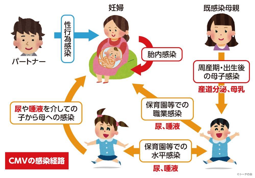 jmt日本看病先天性鉅細胞病毒感染可致幼兒聽力障礙