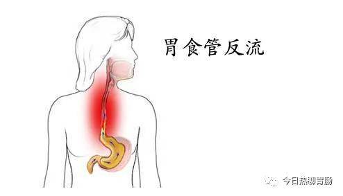 怎么看食道有没有问题 792c7b1c006a470e8b0ac0c163925dfc.jpeg